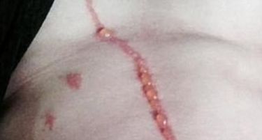 (ФОТО) Бизарно: Пајак живеел три дена под кожата на ова момче!