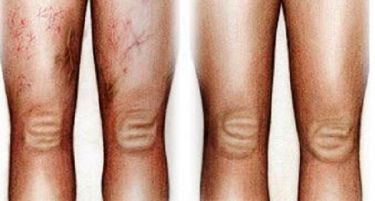 Поради што настануваат проширените вени?