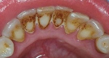 Како да го отстраните сами забниот камен без да одите на стоматолог?