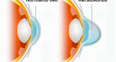 Дознајте која болест на очите се лекува со методата  Крос линкинг
