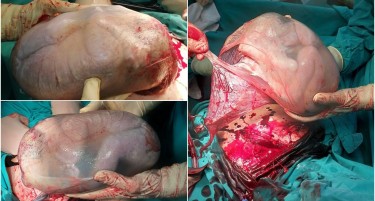 НА ГАК РОДЕНО БЕБЕ БЛИЗНАЧЕ СО АМНИОНСКА ОБВИВКА: Девојчето и неговото братче се во добра состојба