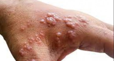 ПРИСТИГНАЛ ОД АВСТРИЈА: Кичевчанецот со можни мајмунски сипаници избегал од болница